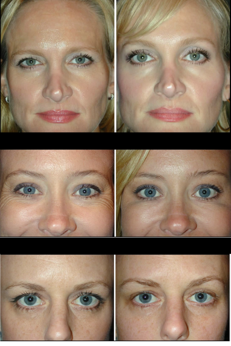 CHEMICAL BROW LIFT JUVERNE